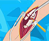 Arm Surgery 2